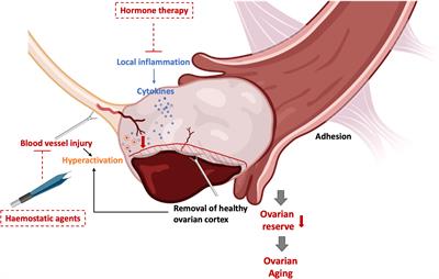 Impacts of endometrioma on ovarian aging from basic science to clinical management